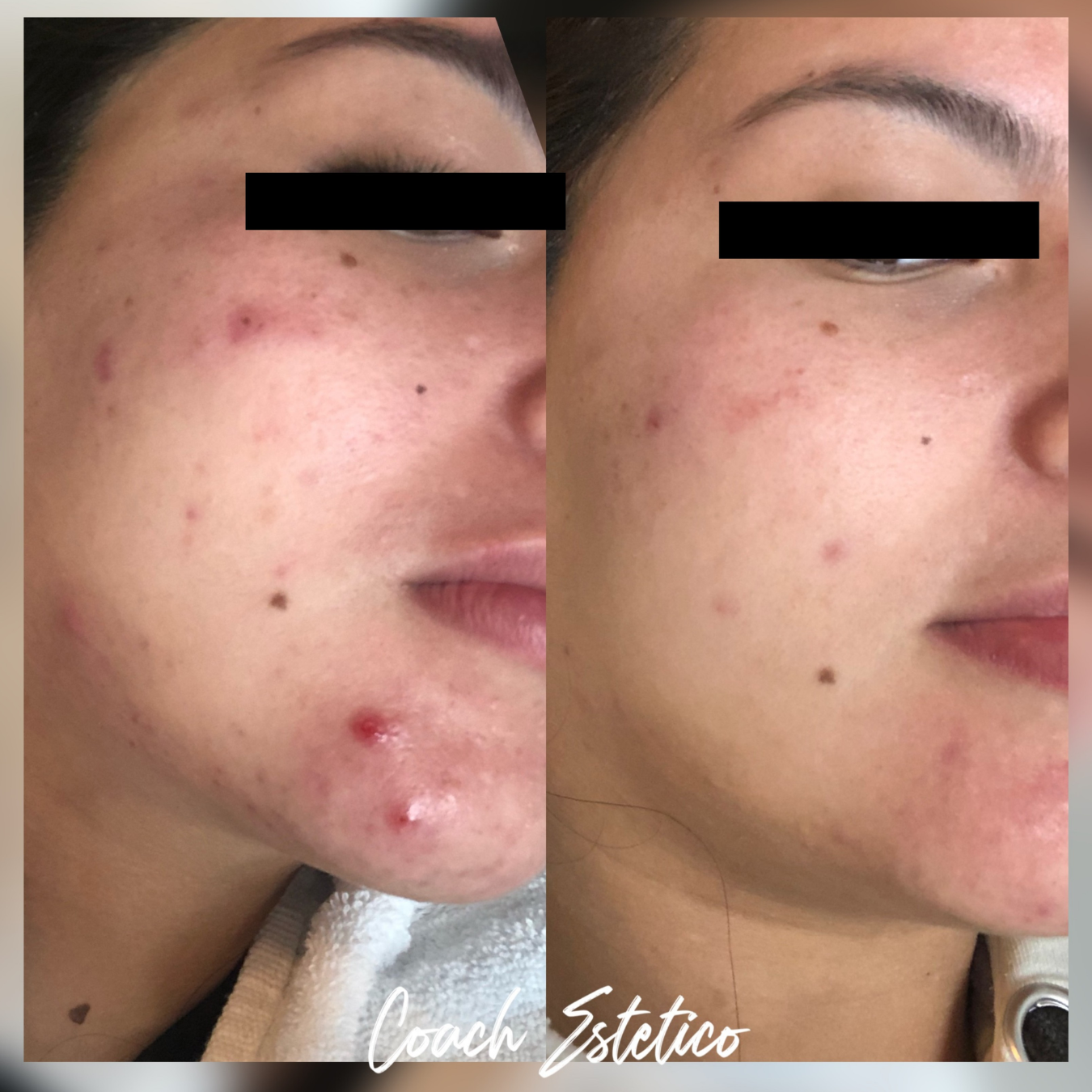 Caso de éxito Hidrafacial: reducción de acné y rojeces en mejilla