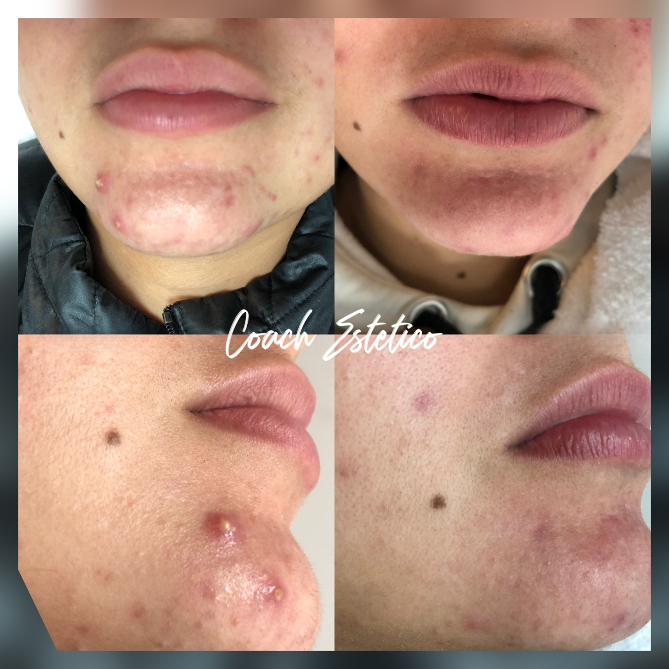 Caso de éxito Hidrafacial: piel más uniforme en zona perioral