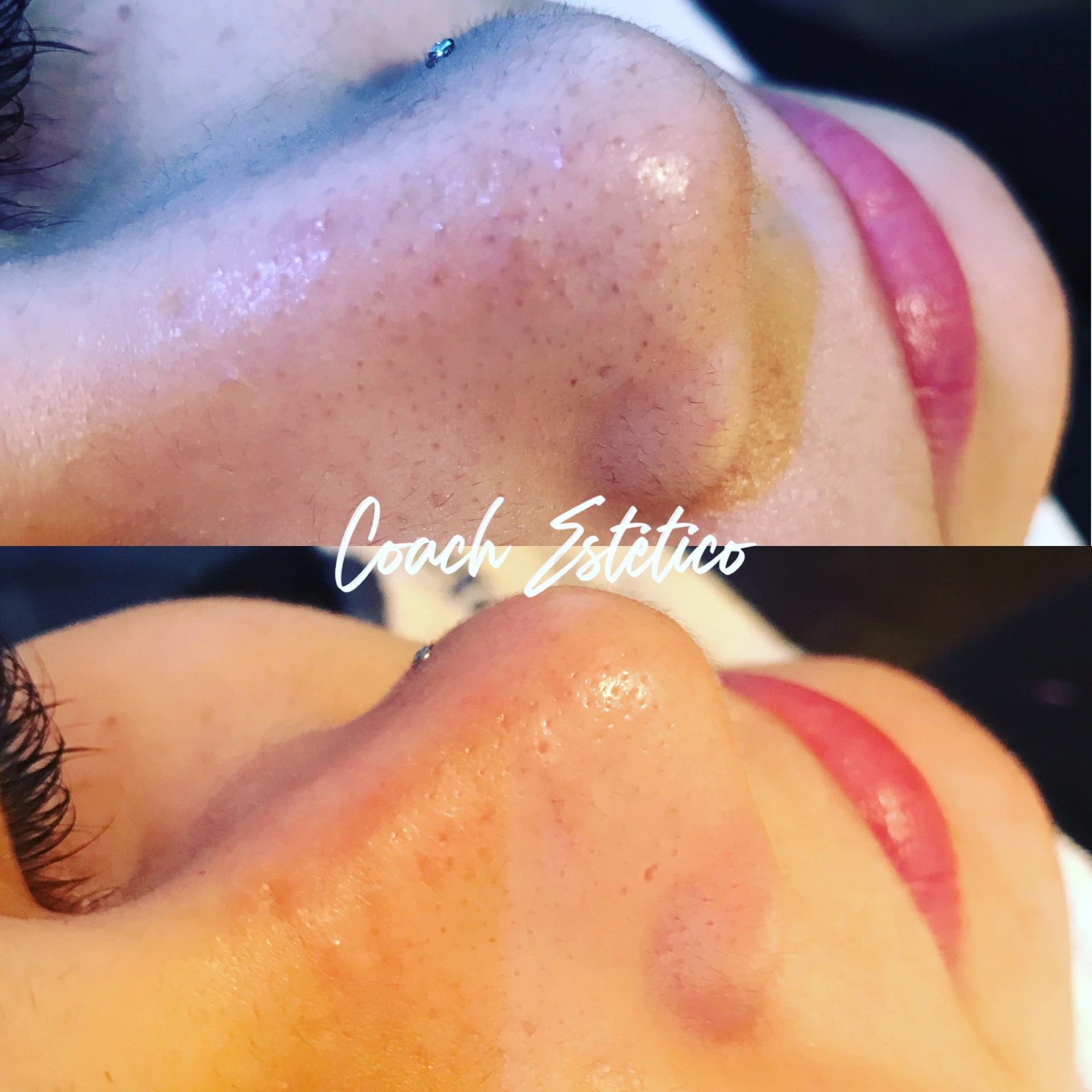 Caso de éxito Hidrafacial: limpieza profunda de poros en nariz