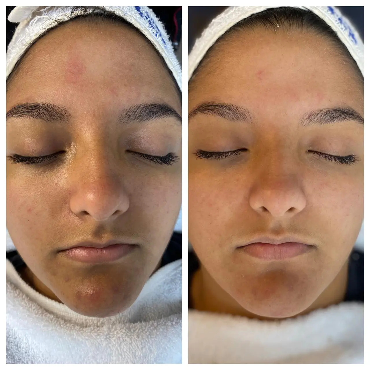 Caso de éxito Hidrafacial: piel luminosa y unificada tras la sesión