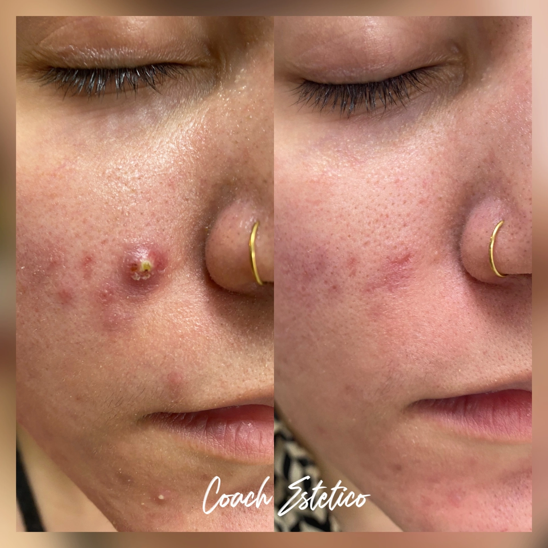 Caso de éxito Hidrafacial: eliminación de impureza inflamatoria