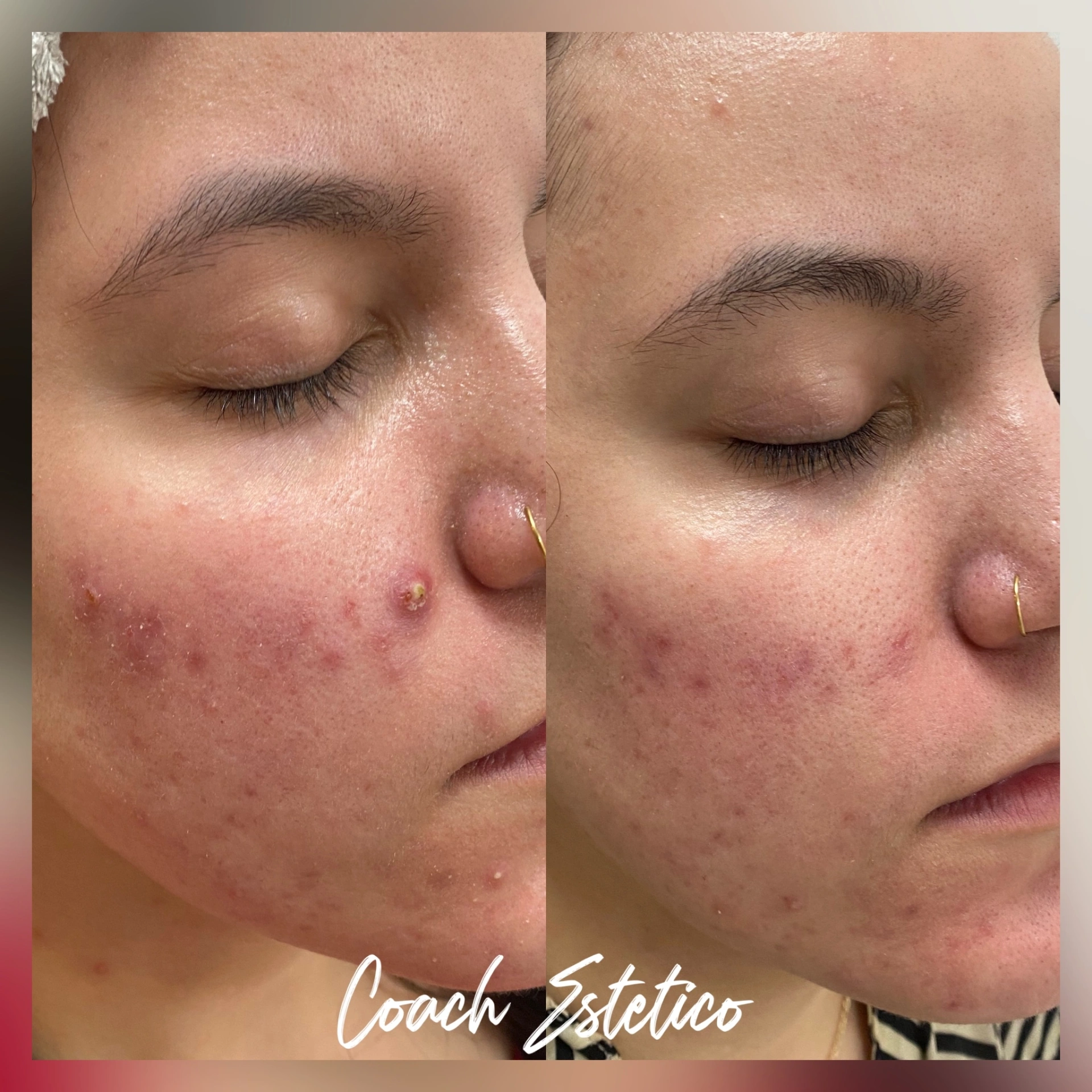 Caso de éxito Hidrafacial: reducción de acné y rojeces faciales